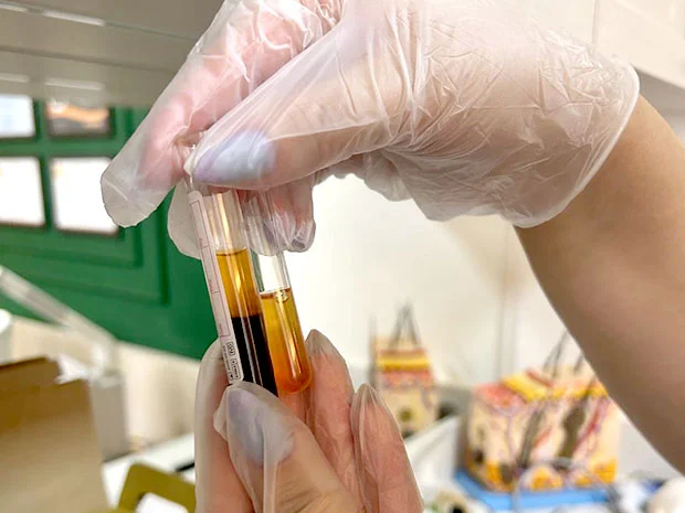 Plasma Rico em Plaquetas (PRP)