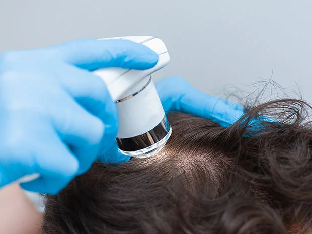 Radiofrequência Microagulhada - Clínica Carol Lima