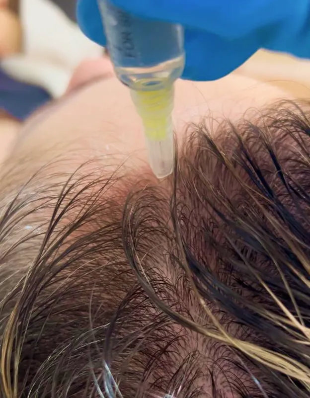 Microinfusão Capilar